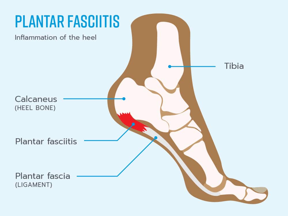 Healthy Street - PLANTAR FASCIITIS SELF-TREATMENT Regular, gentle stretching  of your Achilles tendon and plantar fascia may help to ease your symptoms.  This is because most people with plantar fasciitis have a