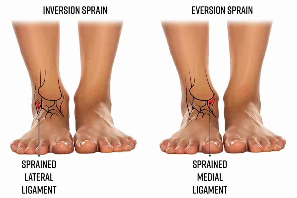 Eversion sprain/strain of the ankle joint involves the ligaments
