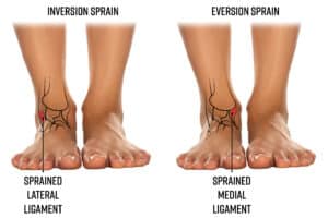 Medial And Lateral Ankle Sprain Physiotherapy