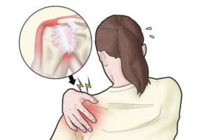 Physiotherapy for frozen shoulder